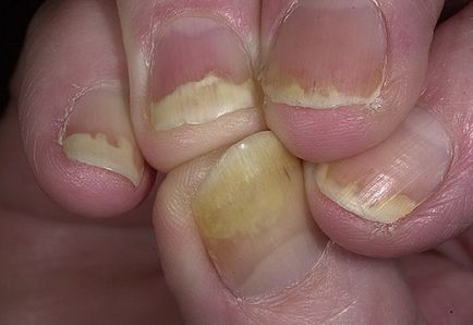 Псоріаз нігтів причини, симптоми і фото
