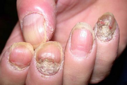 Nail psoriasis okoz, tünetek és fotók