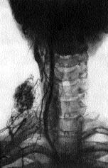 Tiroidian cancer, centrul orașului Kiev de chirurgie endocrină