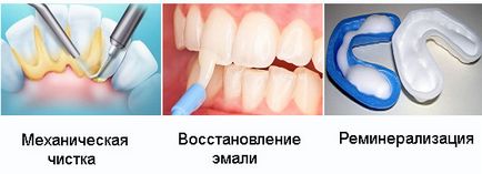 Реминерализация зубів - опис, вартість і препарати
