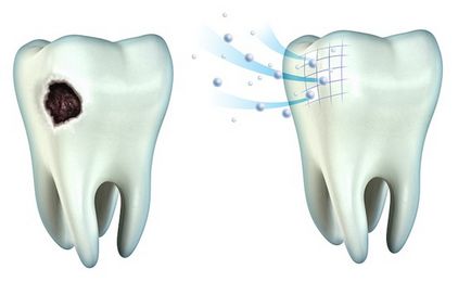 Remineralizarea dinților - descriere, cost și pregătire