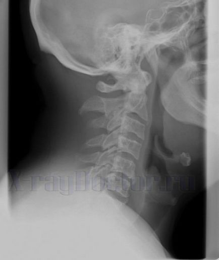 X-ray a laringelui și a gâtului care arată cum și de ce se realizează, imagini