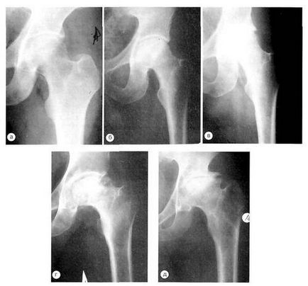 X-ray de oase pelviene cum să pregătească și norma