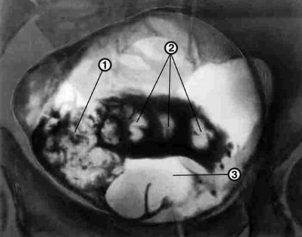 X-ray a preparatului vezicii urinare, comportament, rezultate