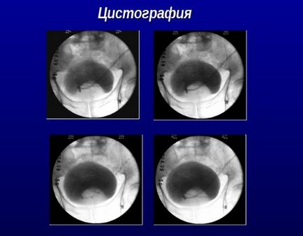 X-ray a preparatului vezicii urinare, comportament, rezultate