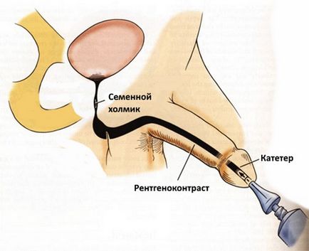 X-ray a preparatului vezicii urinare, comportament, rezultate