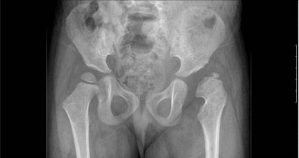 X-ray (radiografie) de pregătire a oaselor pelvine, comportament, rezultate