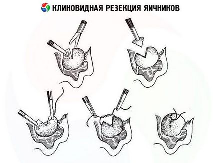 Резекція яєчника клиноподібна, лапароскопічна, компетентно про здоров'я на ilive