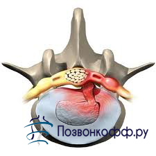 Sechestrarea unui disc herniat este un diagnostic pe care nu-l puteți renunța!