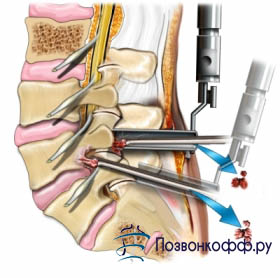 Sechestrarea unui disc herniat este un diagnostic pe care nu-l puteți renunța!