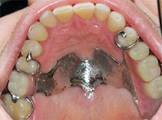 Знімні протези - стоматологічна клініка устадент