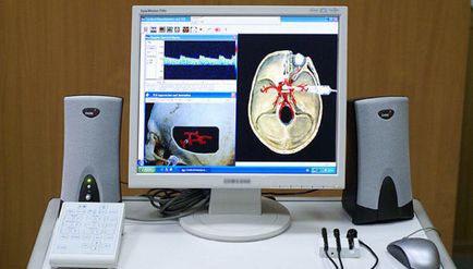 agyi bypass műtét hydrocephalus gyermekeknél és felnőtteknél