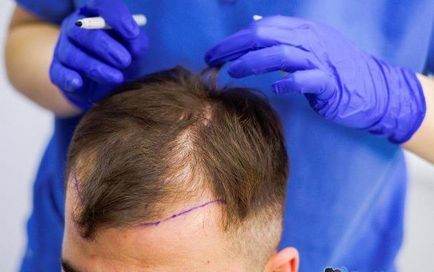 agyi bypass műtét hydrocephalus gyermekeknél és felnőtteknél