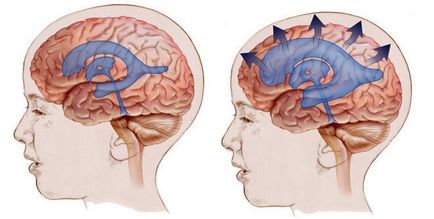 Ștergerea creierului în hidrocefalie la copii și adulți
