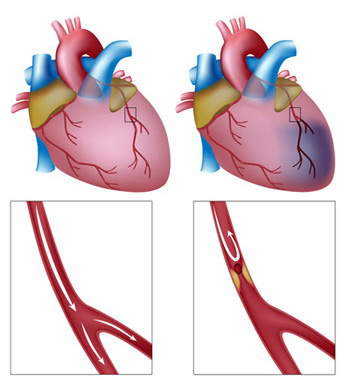 Simptomele infarctului miocardic, prim ajutor pentru infarctul miocardic