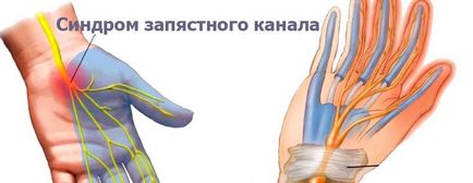 kéztőcsatorna szindróma (alagút szindróma) a tünetek és a kezelés