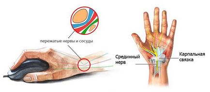 kéztőcsatorna szindróma (alagút szindróma) a tünetek és a kezelés