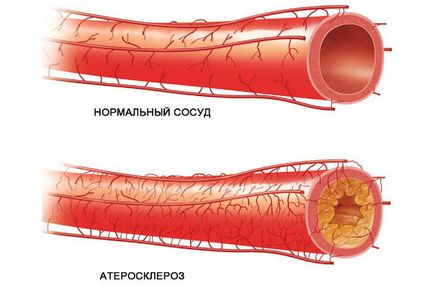 Edényeknek menopauza problémák a kardiovaszkuláris rendszerben