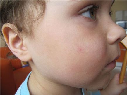 Судинні зірочки на обличчі у дитини причини на щоці (фото), лікування варикозу