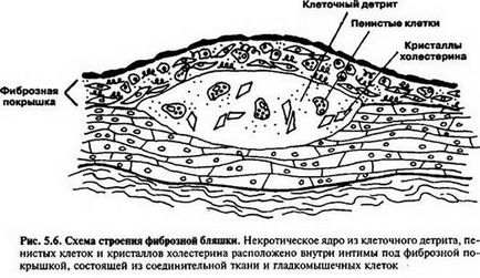 Стадії атеросклерозу опис захворювання, діагностика і лікування