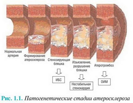 Etapele aterosclerozei, descrierea bolii, diagnosticul și tratamentul