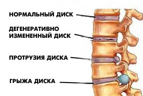 Etapele tratamentului osteocondrozei cu medicamentele folclorice