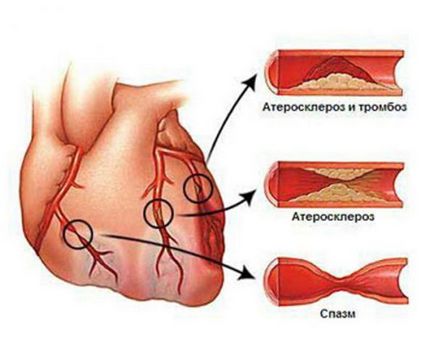 Simptomele anginei pectorale, diagnosticul, tratamentul, consecințele și prevenirea