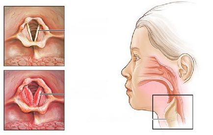 Стенозуючий ларингіт причини, симптоми і лікування