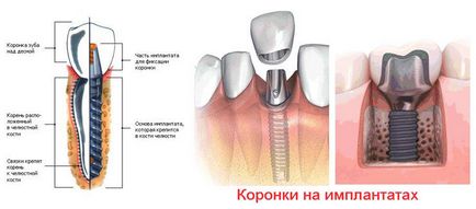Stomatologie în Coreea (implantare în Coreea) Stomatologie în Coreea
