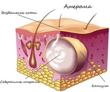 Este ateromul pielii caracteristice tumorii glandei sebacee?