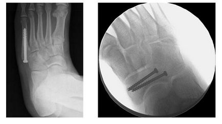Fracturi de stres, fotografie înainte și după, intervenții chirurgicale, recenzii, tratament, reabilitare și recuperare