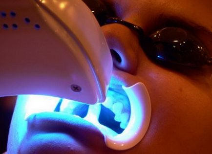 Технології лікування зубів лікування зубів за допомогою стоматологічного лазера