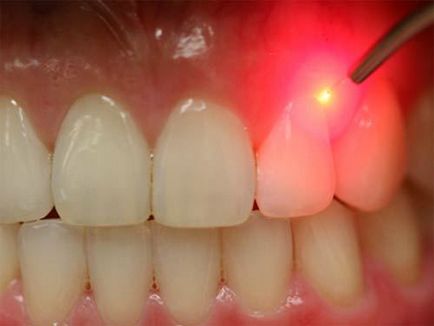 Tehnologii-stomatologie-stomatologie cu un laser dentar