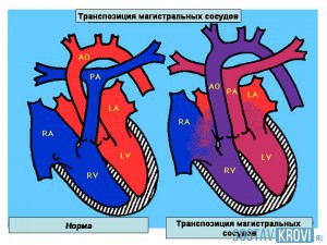 Transpunerea vaselor principale la copii, nou - nascuti, fetusi, cauze, simptome, tratament si