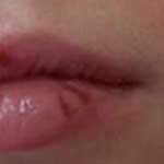 Colțurile gurii sunt crăpate - tratamentul cu medicamente populare - gemul pe buze