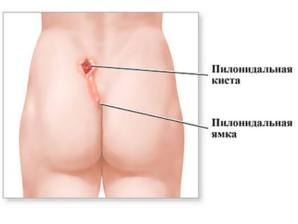 Тривожні симптоми, які вкажуть, що у вас пілонідальная кіста