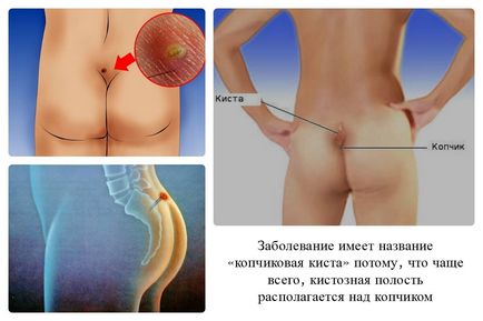 Simptome de anxietate care indică faptul că aveți un chist pilonidal