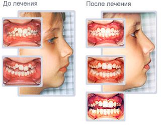 Трейнери для зубів - дитячі і дорослі, відгуки, ціни, фото