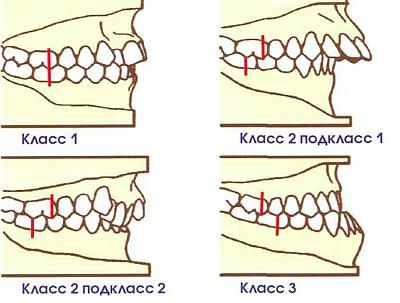 Трейнери для зубів - дитячі і дорослі, відгуки, ціни, фото