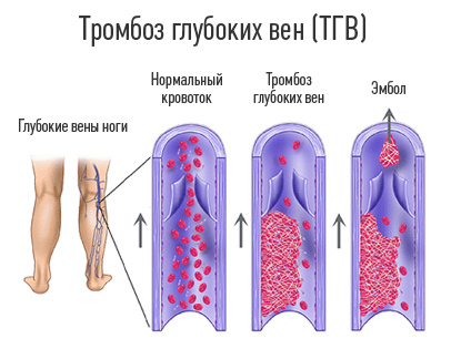 Тромбоз глибоких вен нижніх кінцівок - лікування при болях, операція на вени нижніх кінцівок