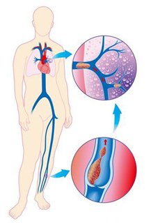 Тромбоза на дълбоките вени на долните крайници - лечение на болки в долната част на операцията крайник вена
