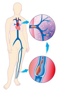 Тромбоз глибоких вен нижніх кінцівок - лікування при болях, операція на вени нижніх кінцівок