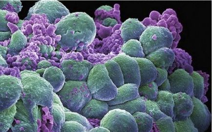 Tulio Simoncini Boala fungică curativă cu cancer