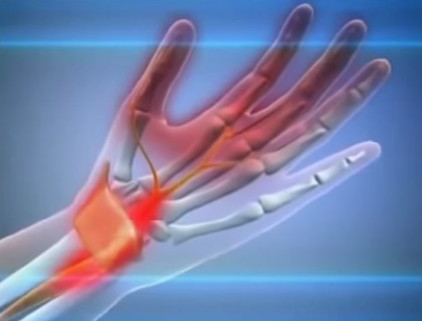 Experiența de tratare a sindromului de mână a tunelului (încheietura mâinii)