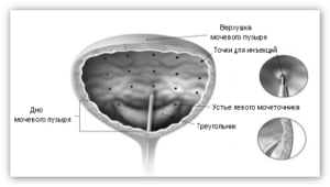 Botox injekciók a húgyhólyagba injektáljuk, terápiás elvek