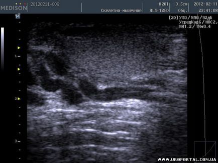 Imagini ultrasunete ale unei singure proceduri - diagnostic cu ultrasunete - metode de examinare în urologie