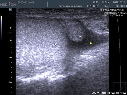 Imagini ultrasunete ale unei singure proceduri - diagnostic cu ultrasunete - metode de examinare în urologie