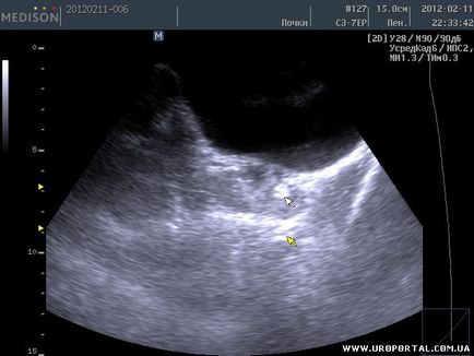 Imagini ultrasunete ale unei singure proceduri - diagnostic cu ultrasunete - metode de examinare în urologie