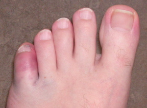 Leziuni ale degetului mic pe picior care provoacă cauze și simptome ale traumei, cum se tratează