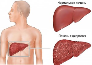 Transfuzia cu ultrasunete la ficat este norma, ceea ce înseamnă ficat alb pe uzi, granularitatea ficatului ceea ce este